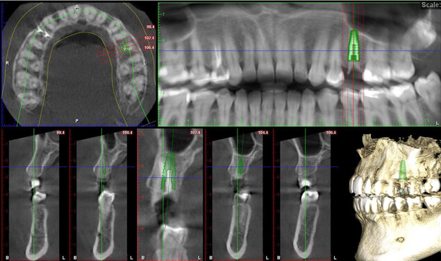 14 cavities CT scan