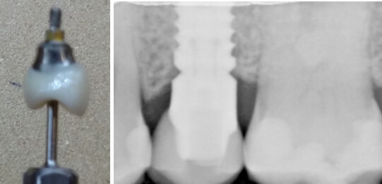 14 cavities implant