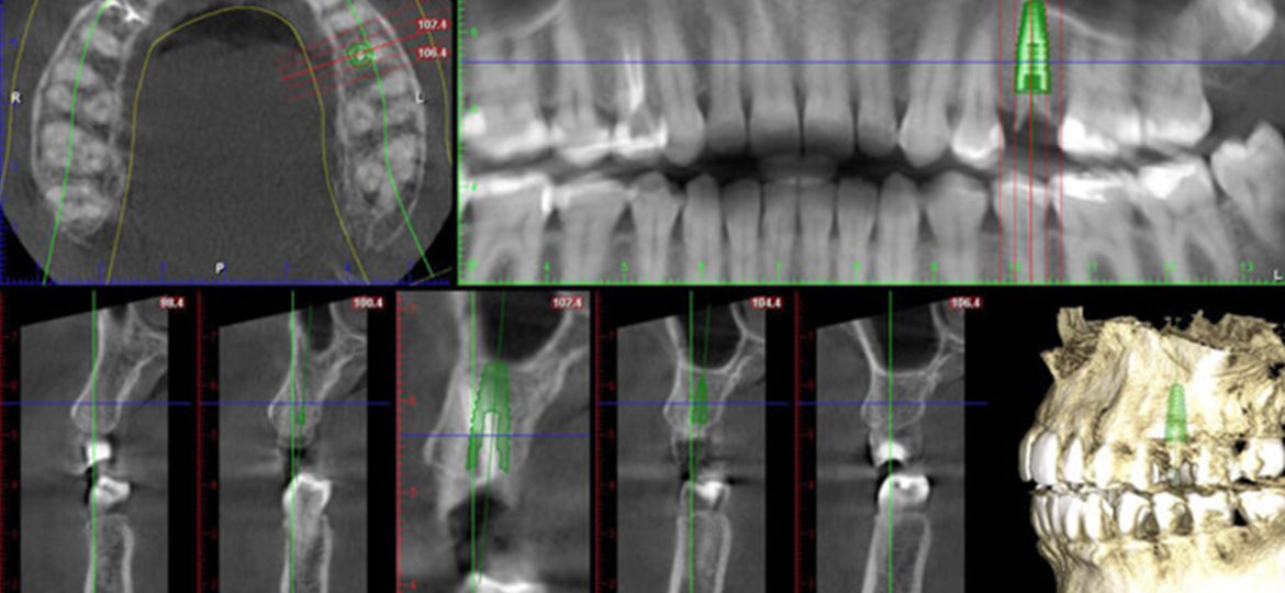 14 Cavities and a Missing Tooth: What Happens Next?