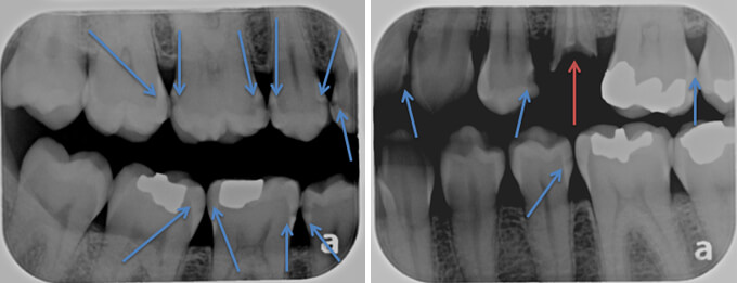 14 cavities x-ray
