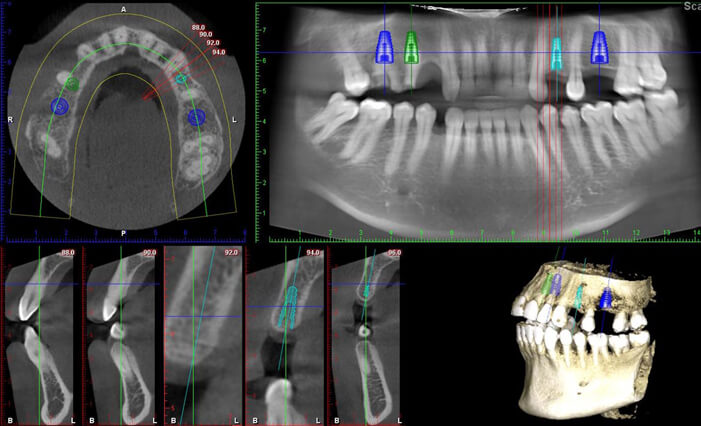 Case planning – 3D CT technology