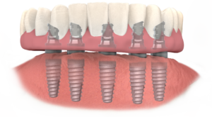 TeethXpress with Prosthesis