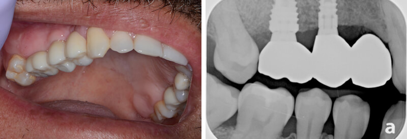 After – Implant Crowns in Place