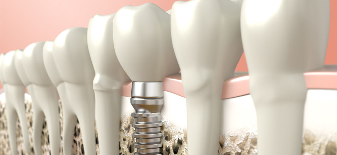 Choosing the Best Dentist for Dental Implants