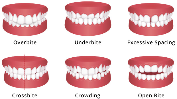 Common Dental Bite Problems