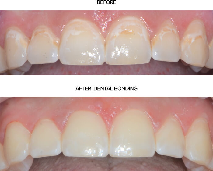 Dental bonding before and after