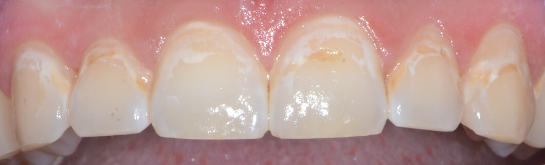White, yellow and brown tooth discoloration from braces