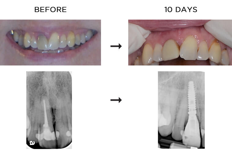 Broken front tooth before and after