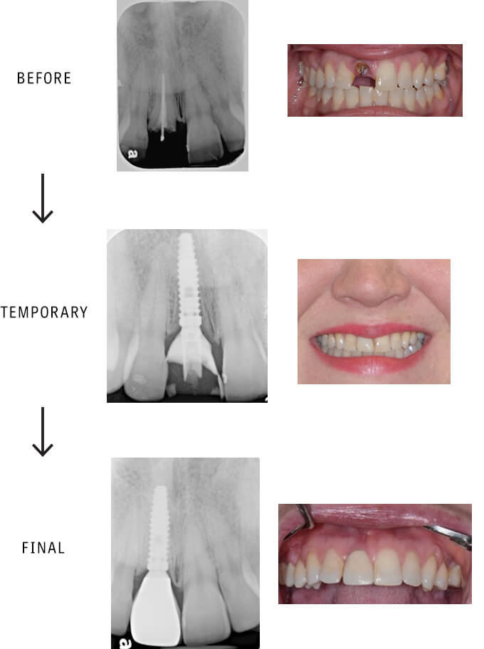 Broken Front Tooth Restoration