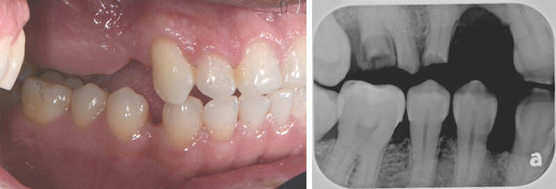 Before – Broken, infected teeth