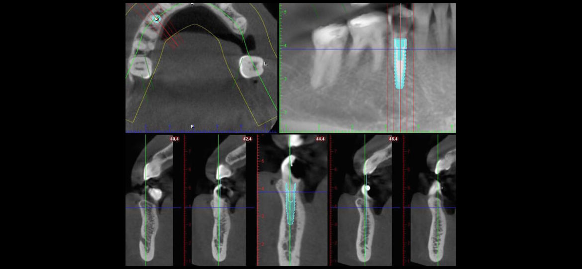 Tooth In A Day Series: Broken Tooth with a Cavity