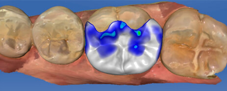 Computer Design of Tooth Restoration