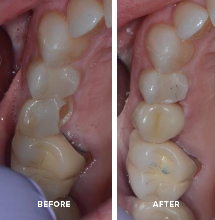 Same-day crown before and after