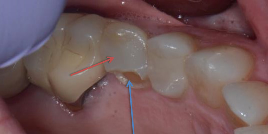 Broken tooth before