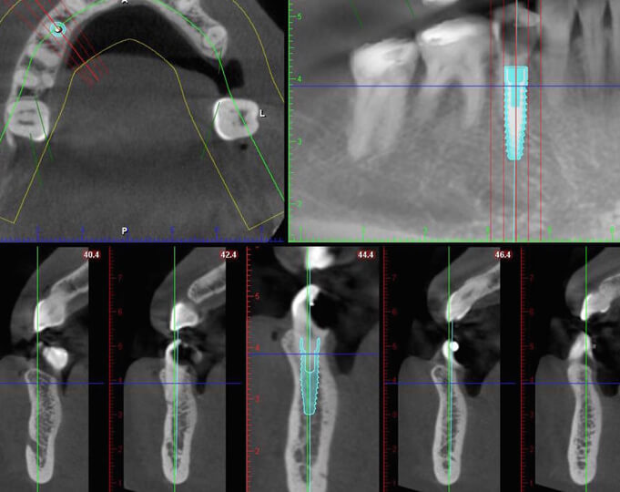 Broken Tooth CT San Planning