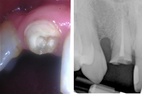 Broken tooth and xray