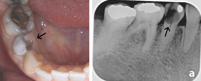 Broken Tooth X-ray