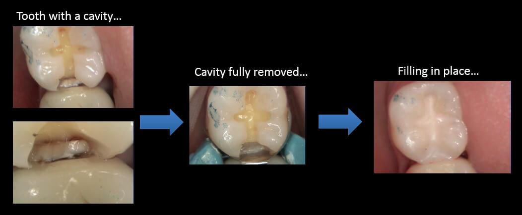 Cavity before and after