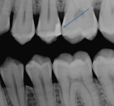 Cavity with filling after one year