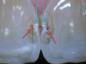 What a cavity looks like on front teeth