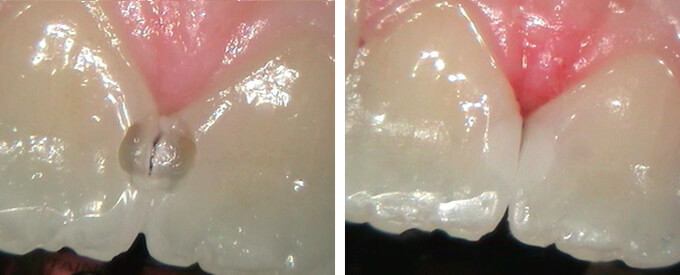 Cavity before and after