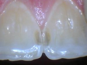 Cavity removed on front teeth