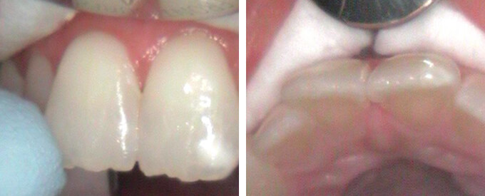 Cavity on upper two front teeth