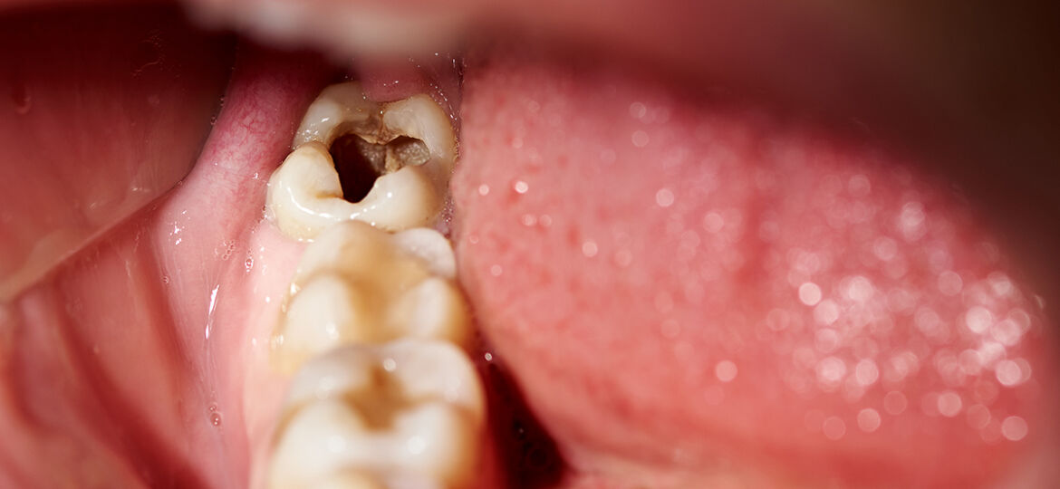 Are there home remedies for cavities?