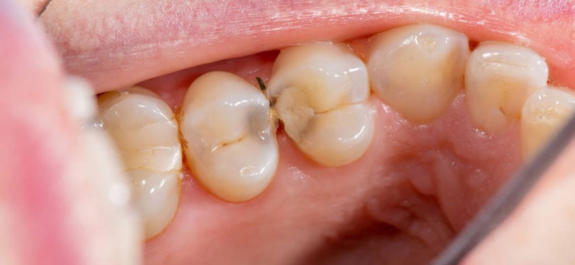 What Tooth Decay Looks Like: Unveiling the Appearance of Cavities