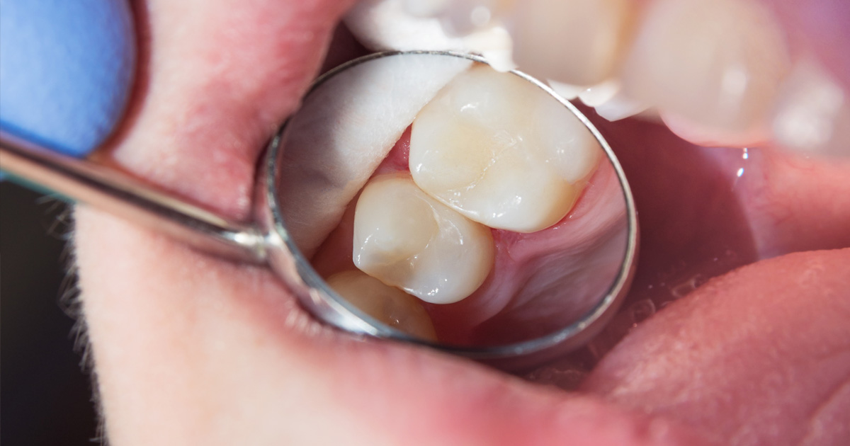 What Does A Cavity Look Like? | Mint Hill Dentistry