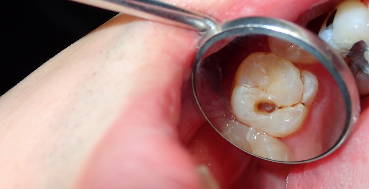 Photo of a cavity