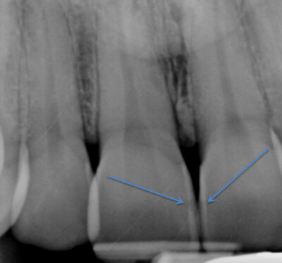 Cavity x-ray on front teeth