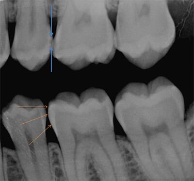 Diagnosing a cavity