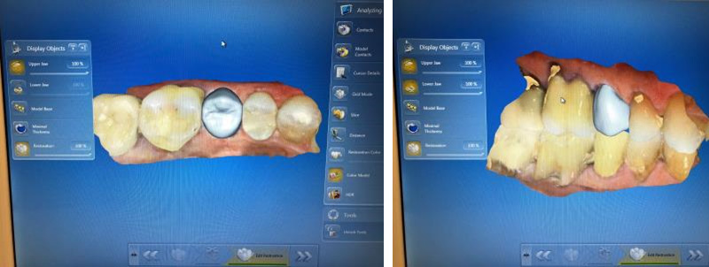 Digital design using CEREC