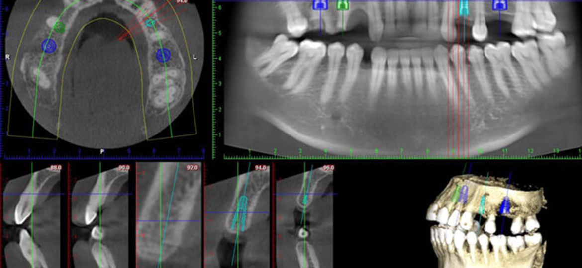 Change Your Smile with Dental Implants