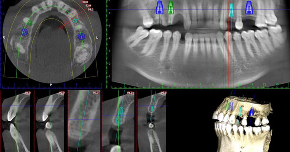 Change Your Smile with Dental Implants