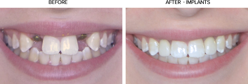 Congenitally Missing Lateral Incisors Before and After