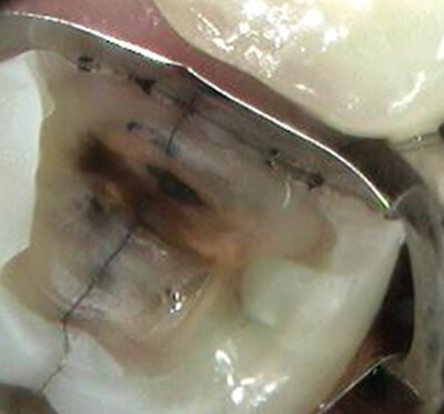 Cracked tooth after filling has been removed