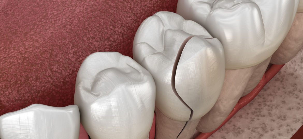 What is ‘Cracked Tooth Syndrome?’