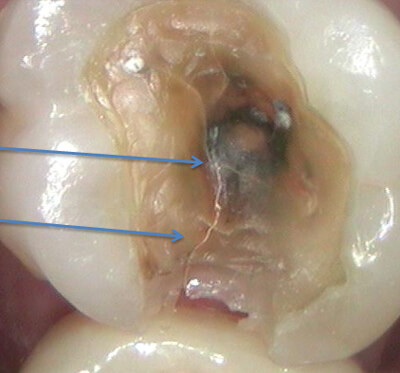 Cracked tooth with filling removed