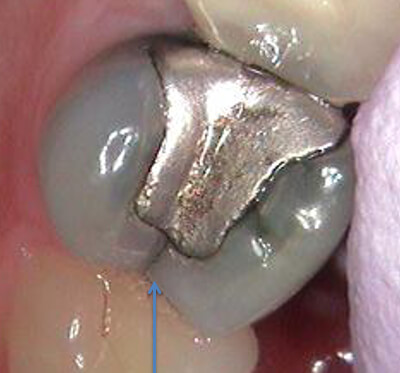 Cracked tooth with metal filling
