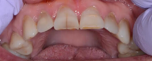 Craze line on front tooth