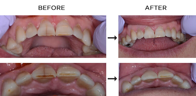 What Causes Craze Lines on Front Teeth?