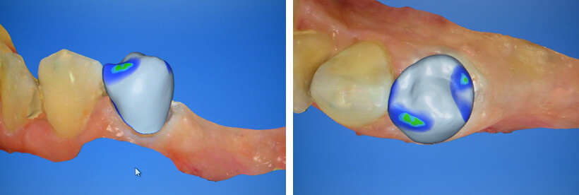 Digital design of dental crown