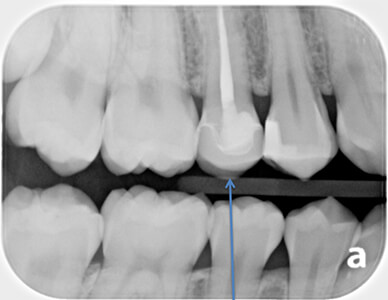 Crowning the root canalled tooth