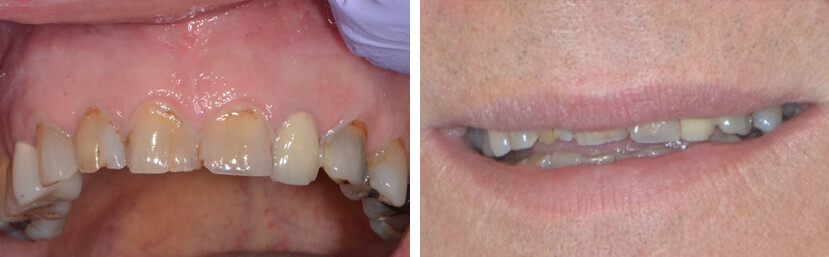 Smile Analysis for dental crowns