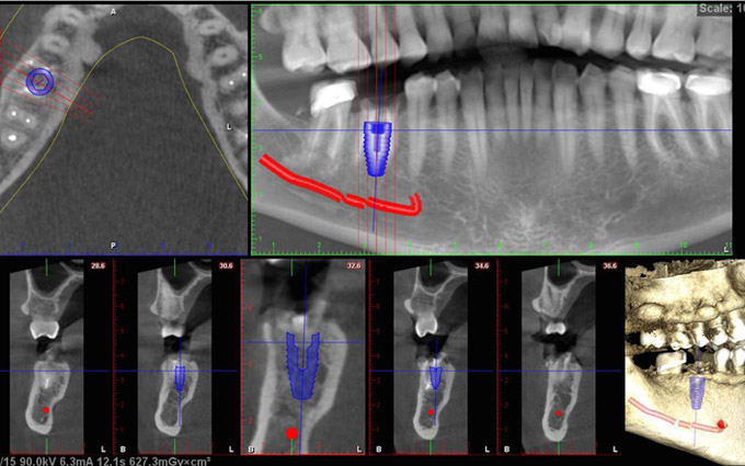 CT scan of broken tooth