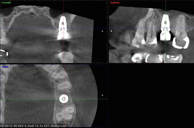 Implant placed - CT after healing