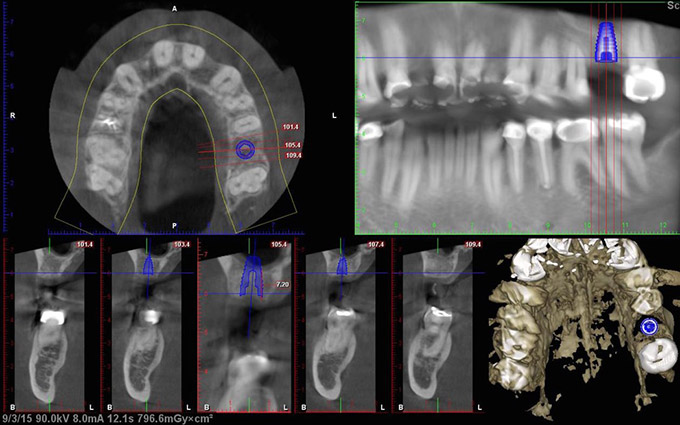 CT plan for implant placement