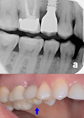 Fractured Tooth After Treatment